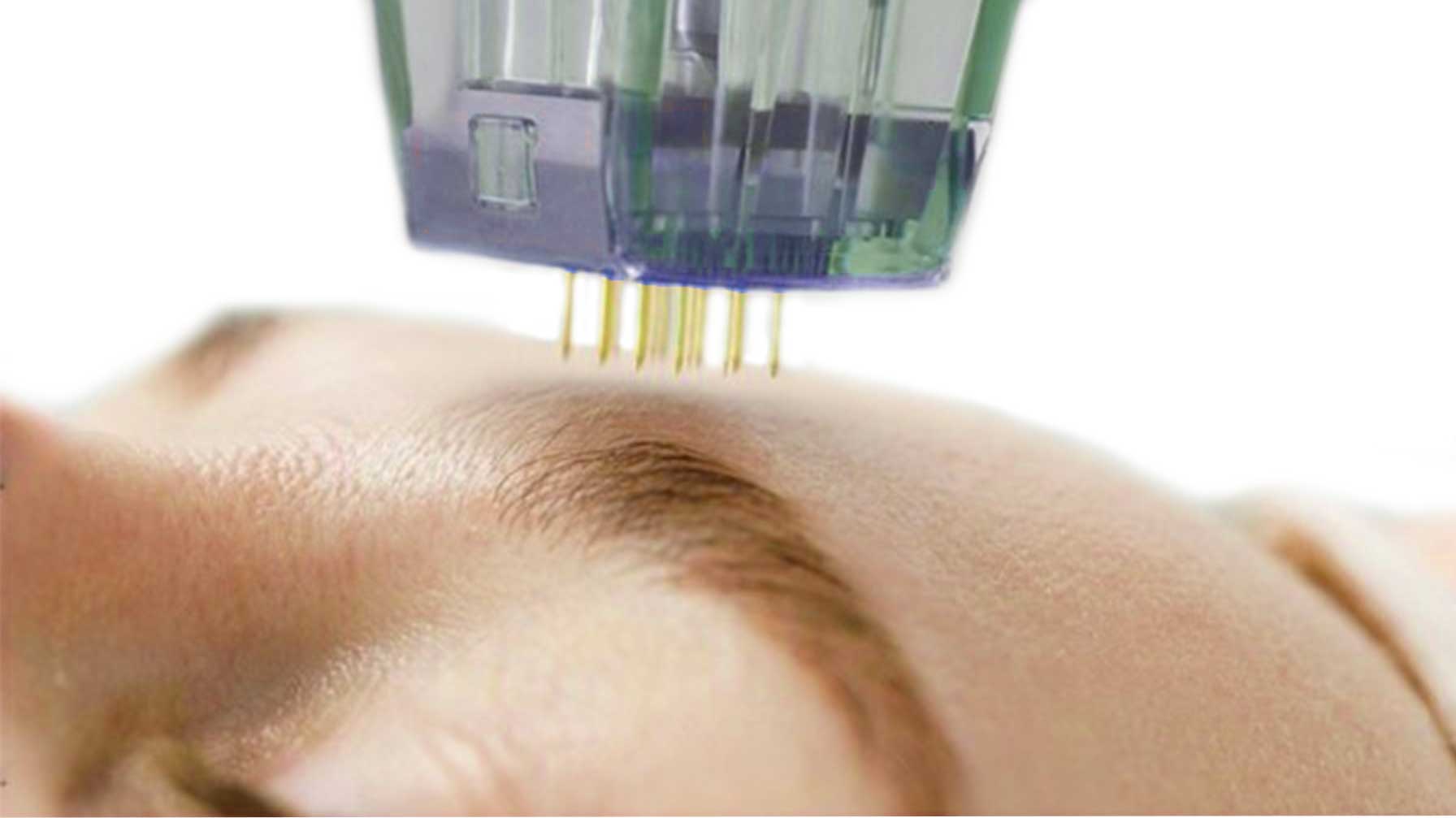 Fraksiyonel Radyofrekans