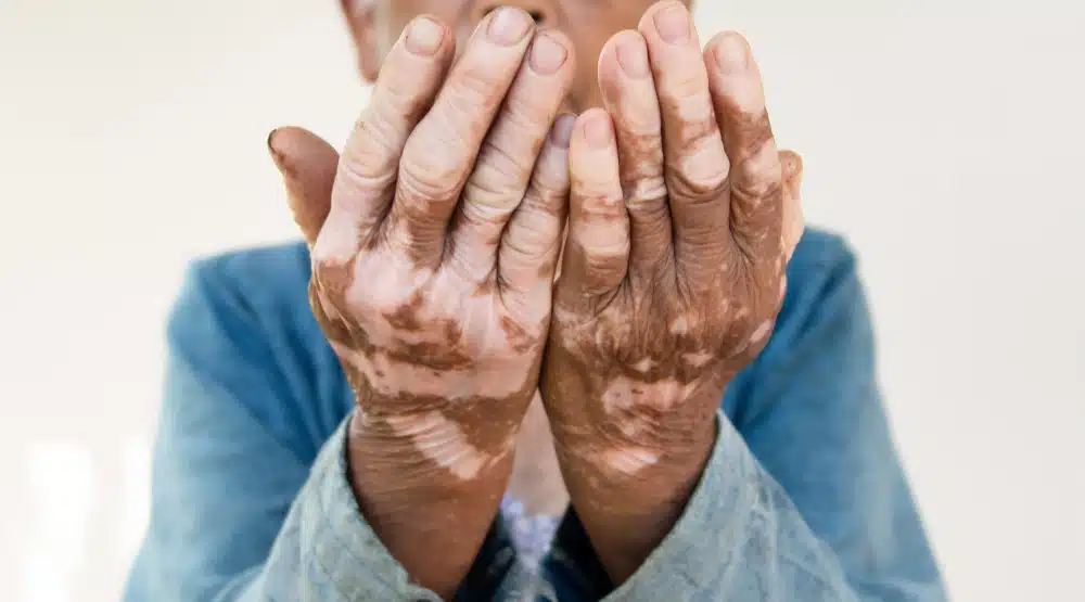 Vitiligo Nedir